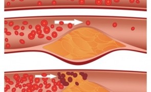 colesterol artere