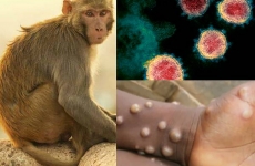 variola maimutei 